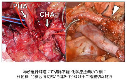 切除不能膵癌に対するConversion surgery