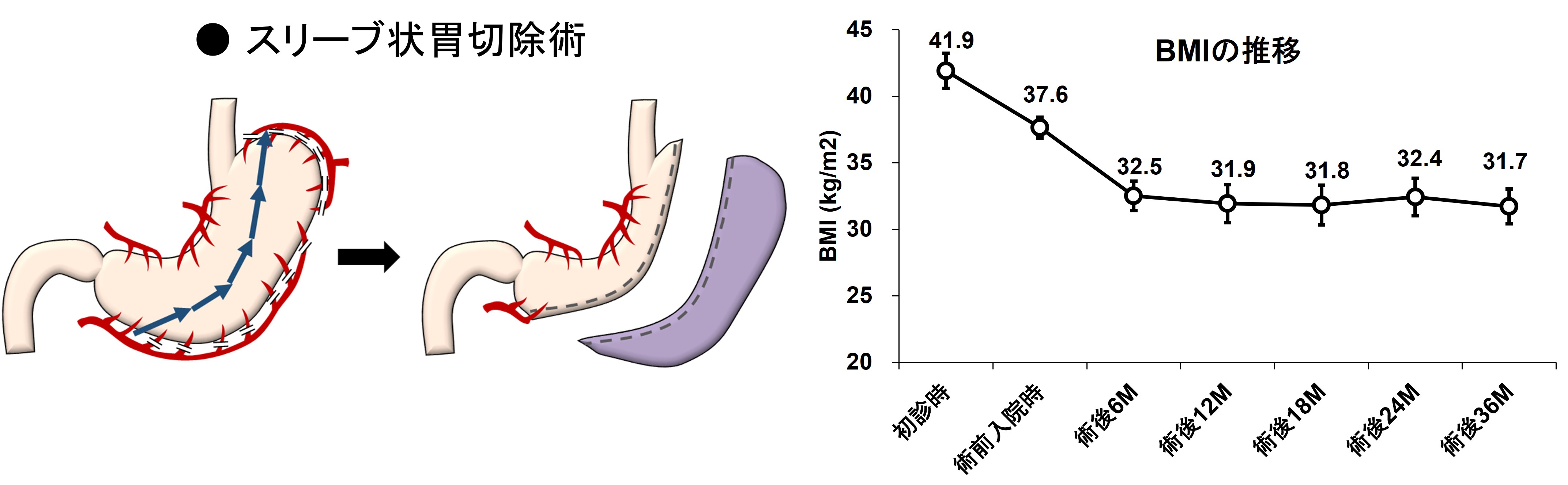肥満症手術とその治療成績