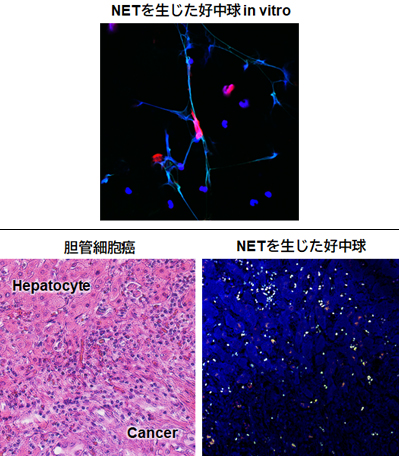 好中球 Neutrophil Extracellular Traps と癌